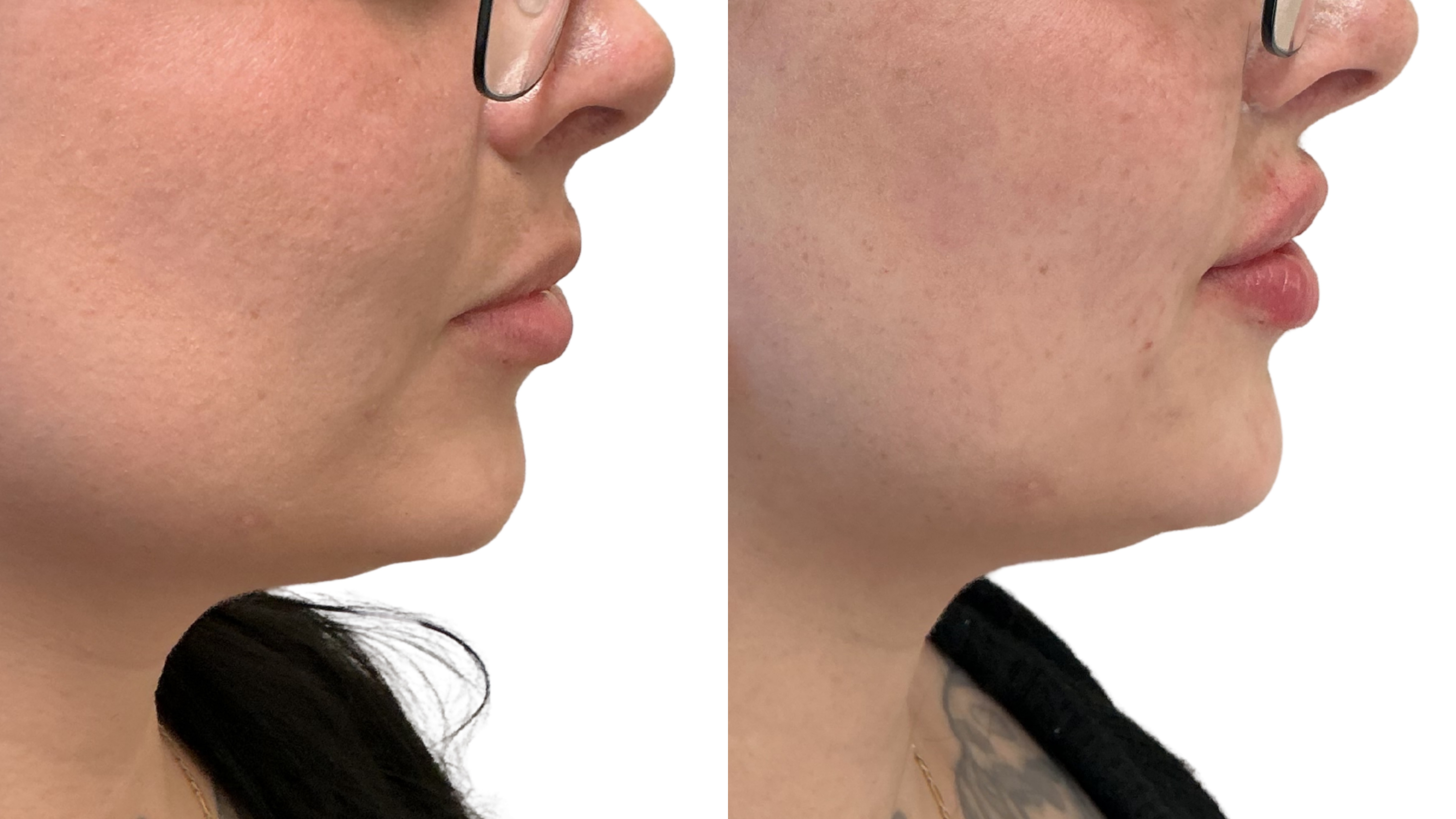 Lip Filler