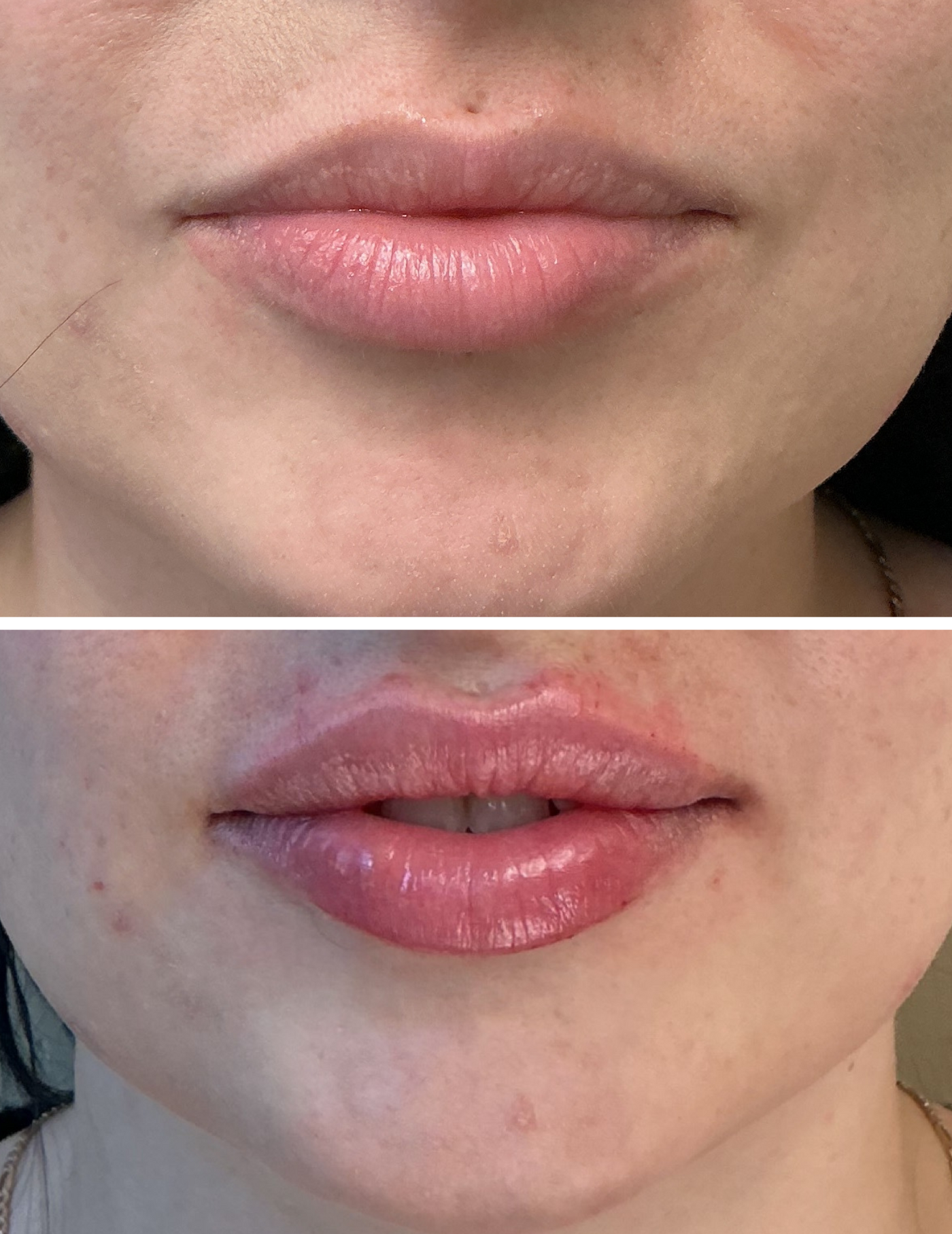 Before and after lip filler results at HoneMD