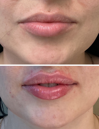 Before and after lip filler results at HoneMD