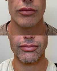 Before and after lip filler results on a male client at HoneMD