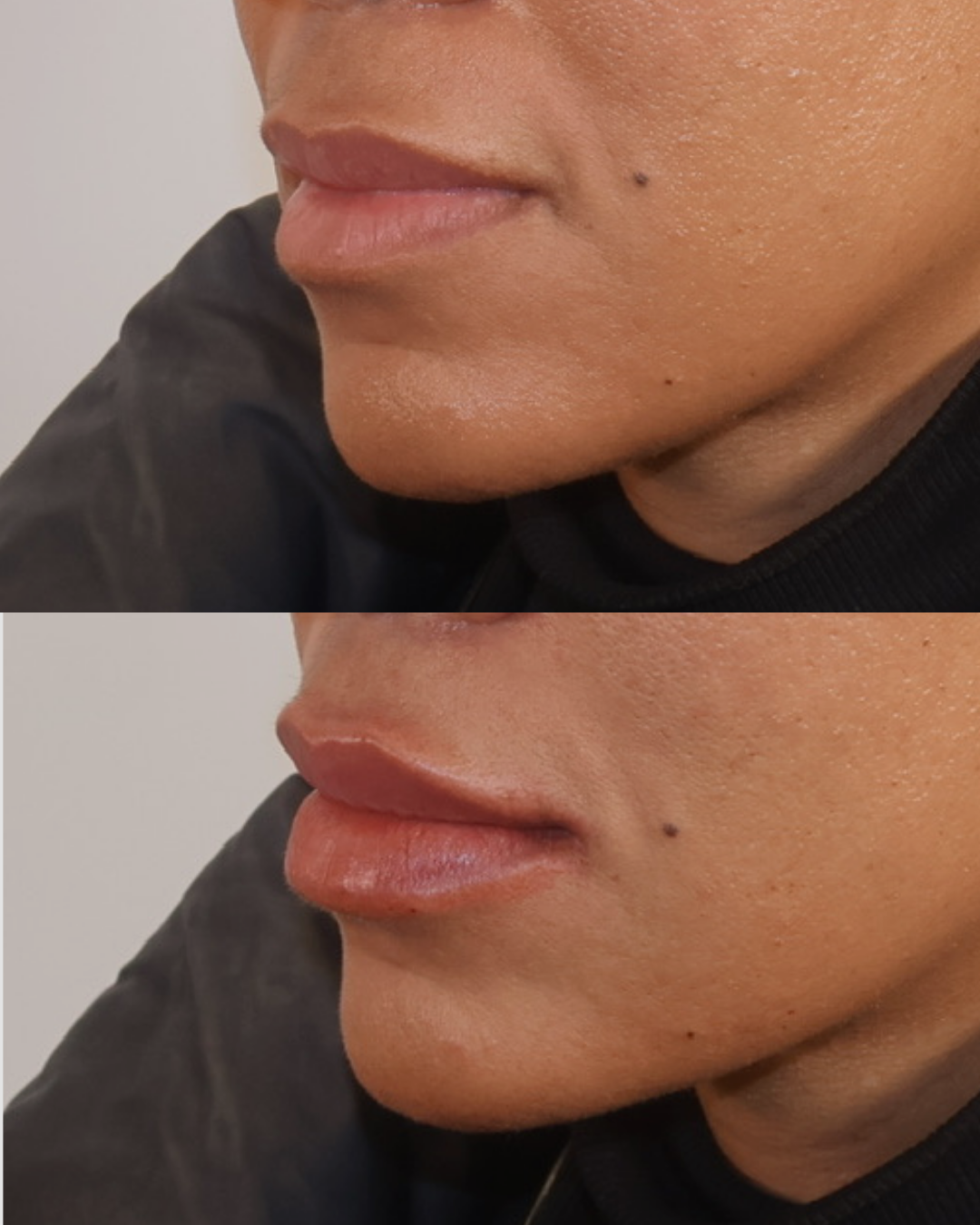 Before and after lip filler results shown in profile at HoneMD