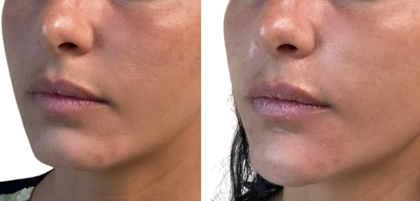 Before and after chin filler results at HoneMD