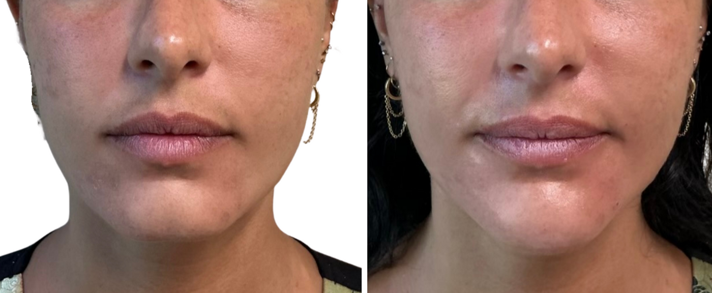 Before and after chin filler results from the front at HoneMD