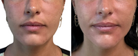 Before and after chin filler results from the front at HoneMD