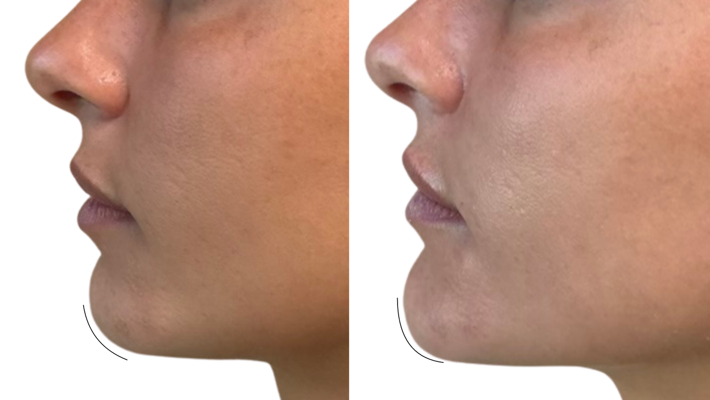Before and after chin filler results shown in profile at HoneMD