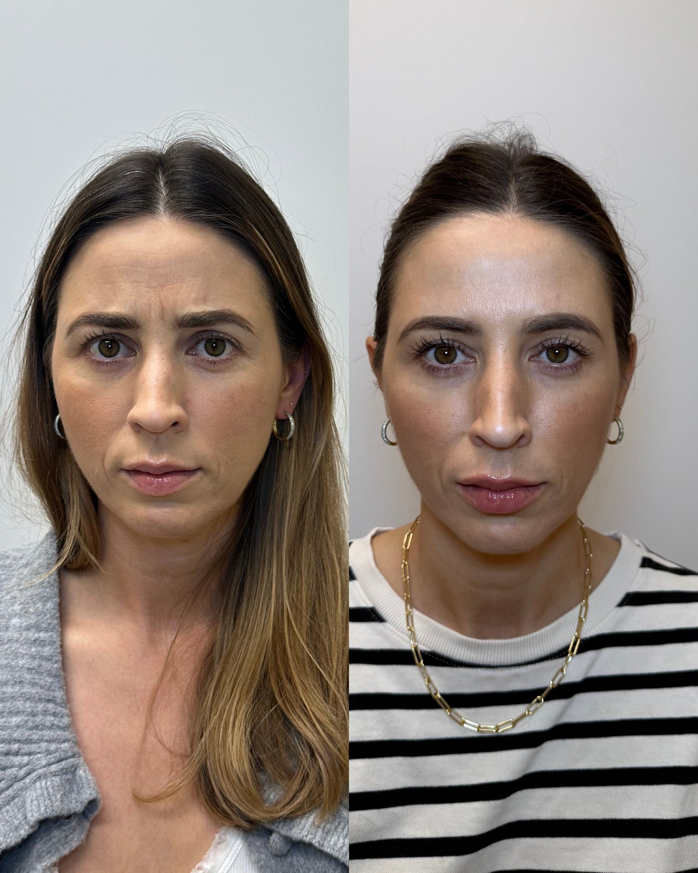 Before and after forehead line treatment results at HoneMD