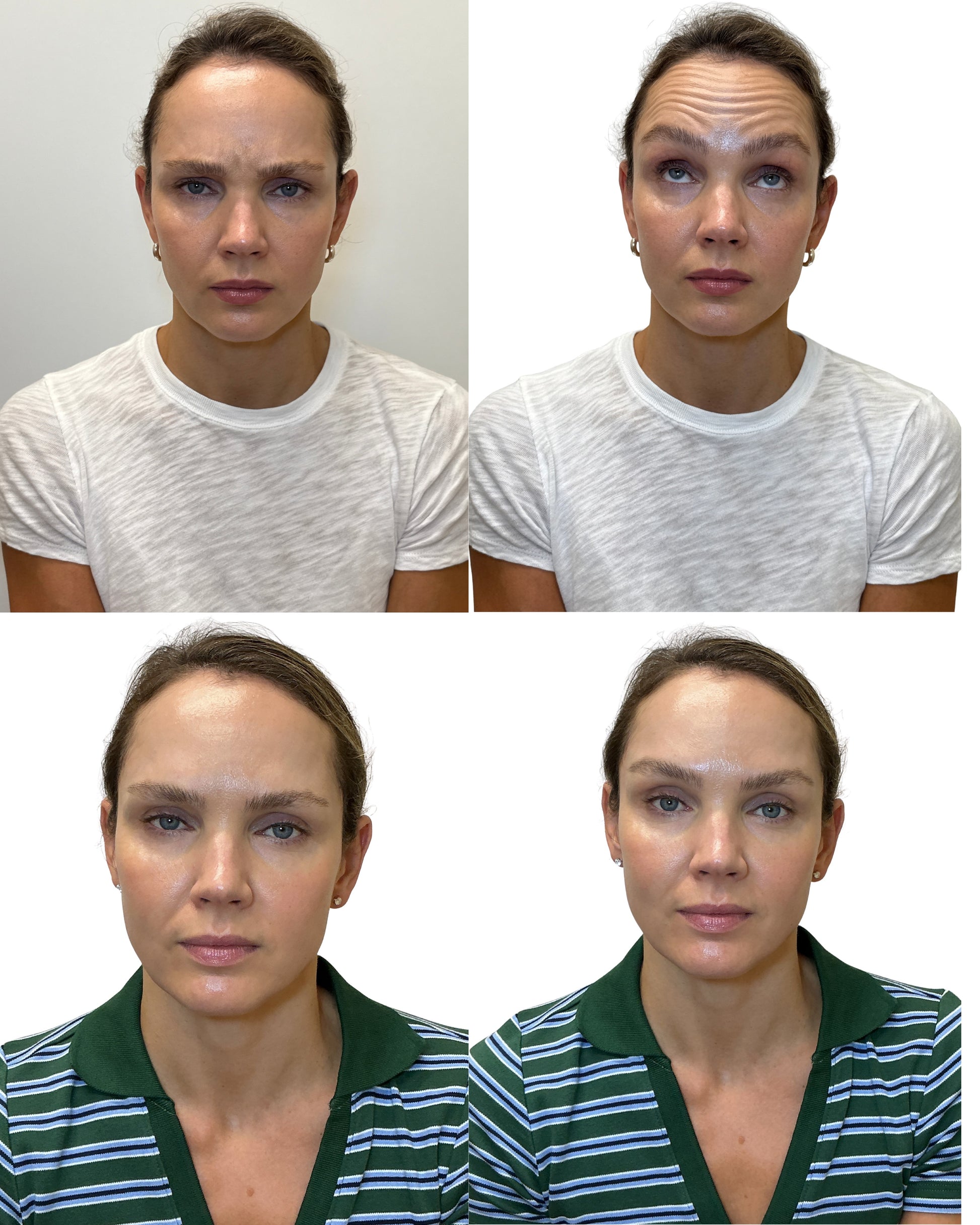 Before and after of frown lines anf forehead lines treatment showing smoother glabella and reduced 11 lines at HoneMD Torrance