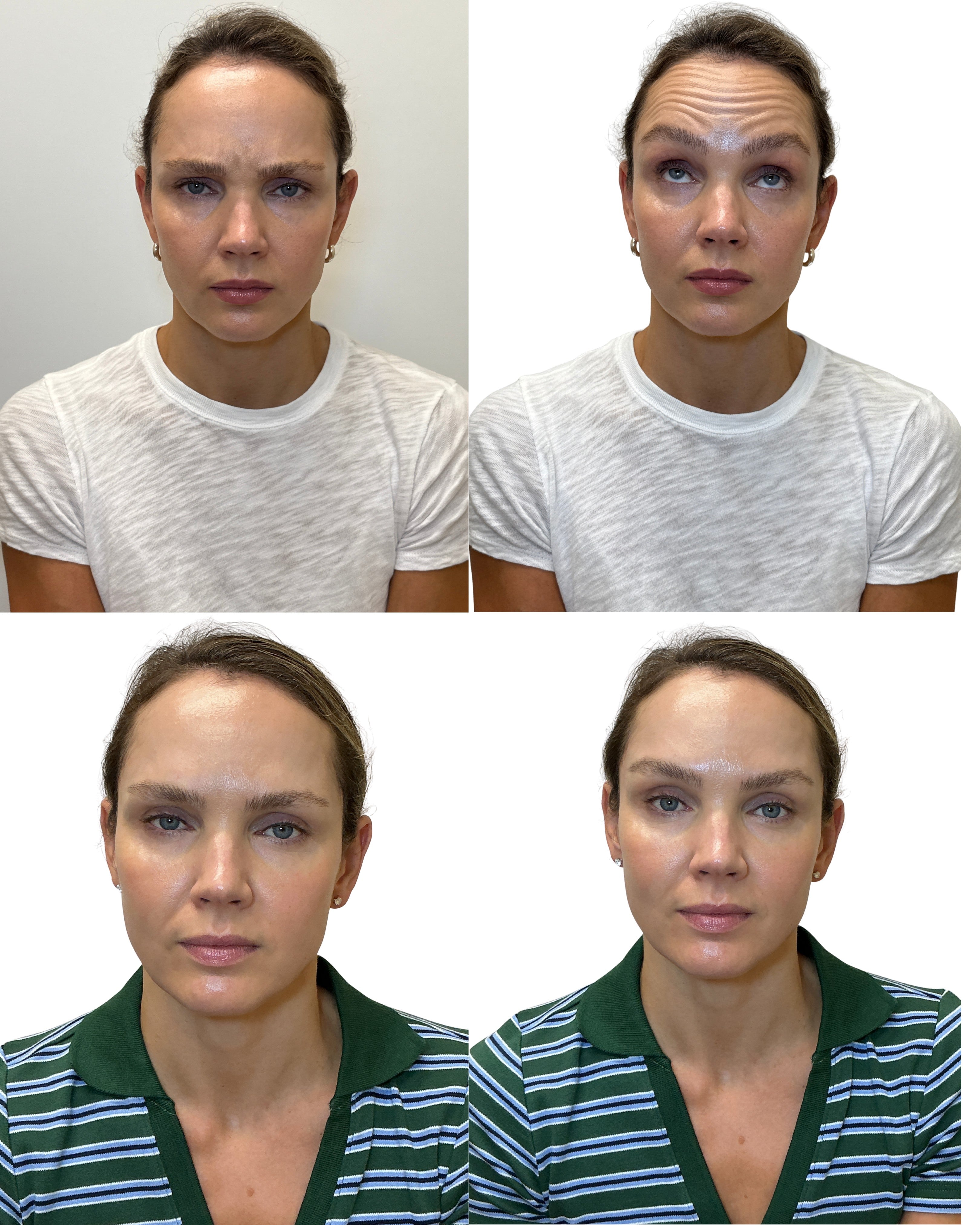 Before and after of frown lines anf forehead lines treatment showing smoother glabella and reduced 11 lines at HoneMD Torrance