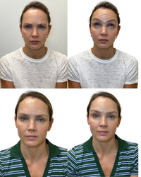 Before and after frown line treatment results at HoneMD
