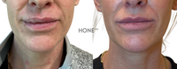 Before and after lip filler dissolving results at HoneMD