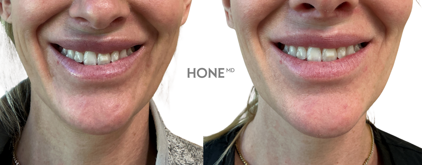 Before and after lip filler dissolving results with a smile at HoneMD