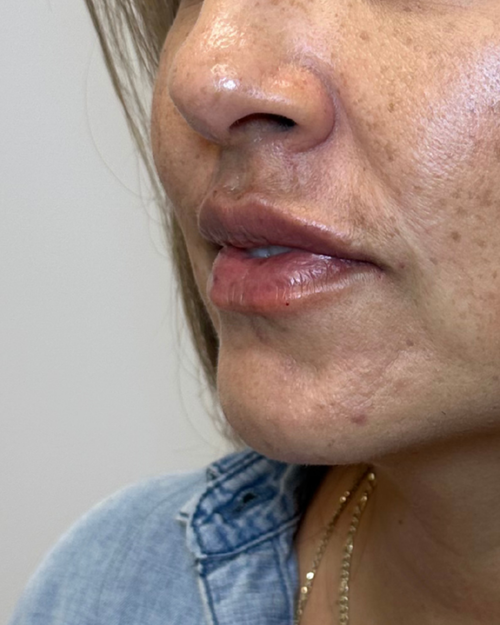 After — Lip Refinement