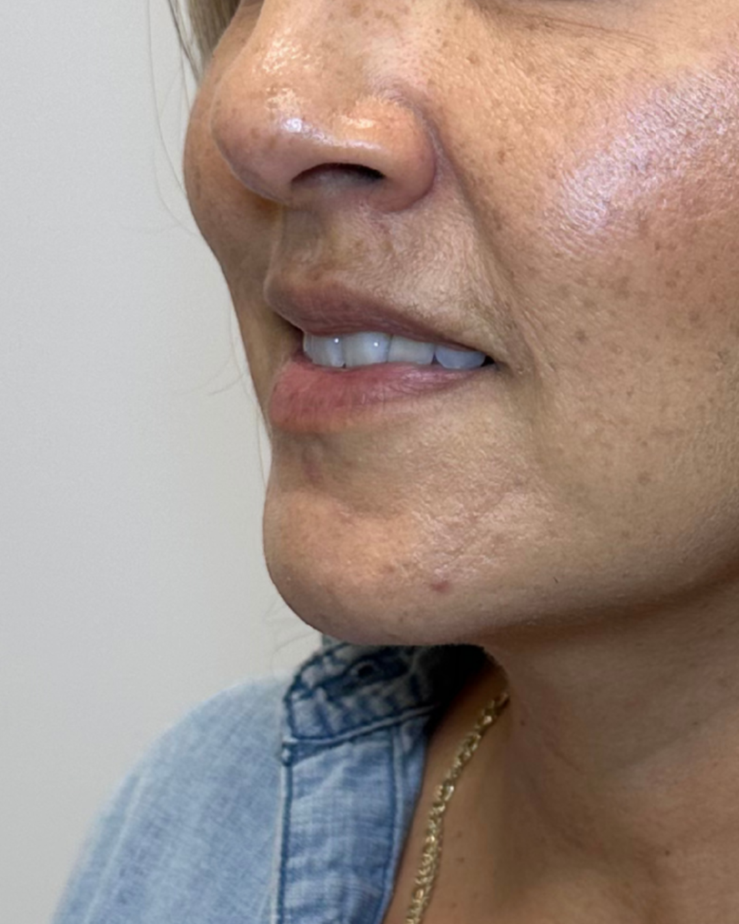 HoneMD Torrance lip refinement - before