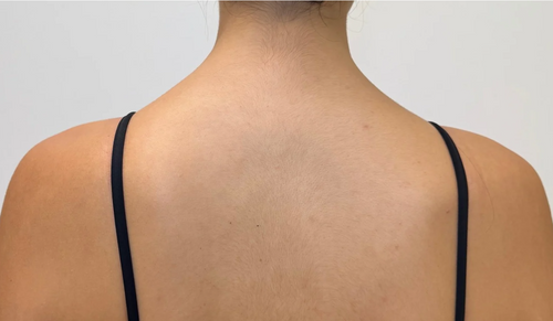 After — Barbie Trap Tox