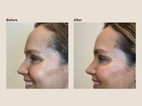 Before and after crow's feet wrinkle relaxer results at HoneMD