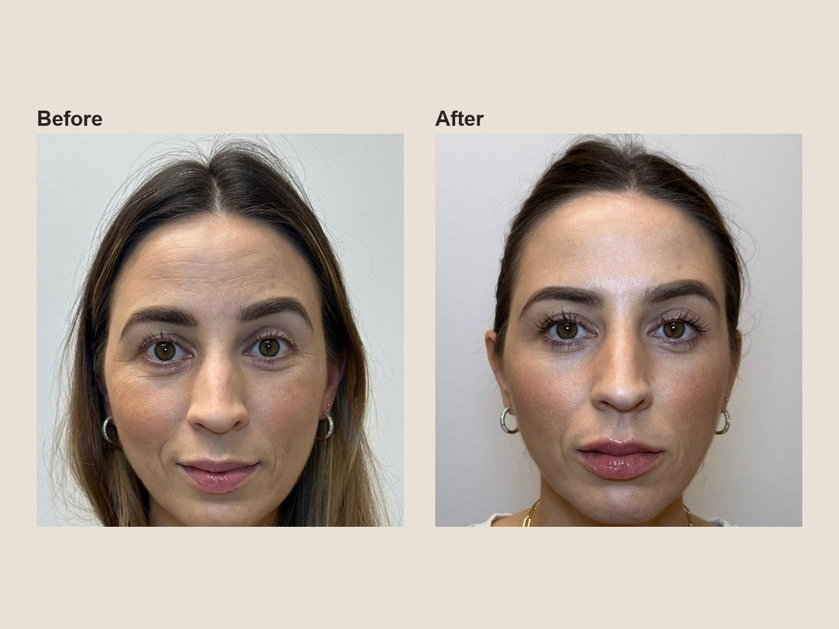 Before and after lip filler results at HoneMD