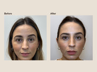 Before and after lip filler results at HoneMD