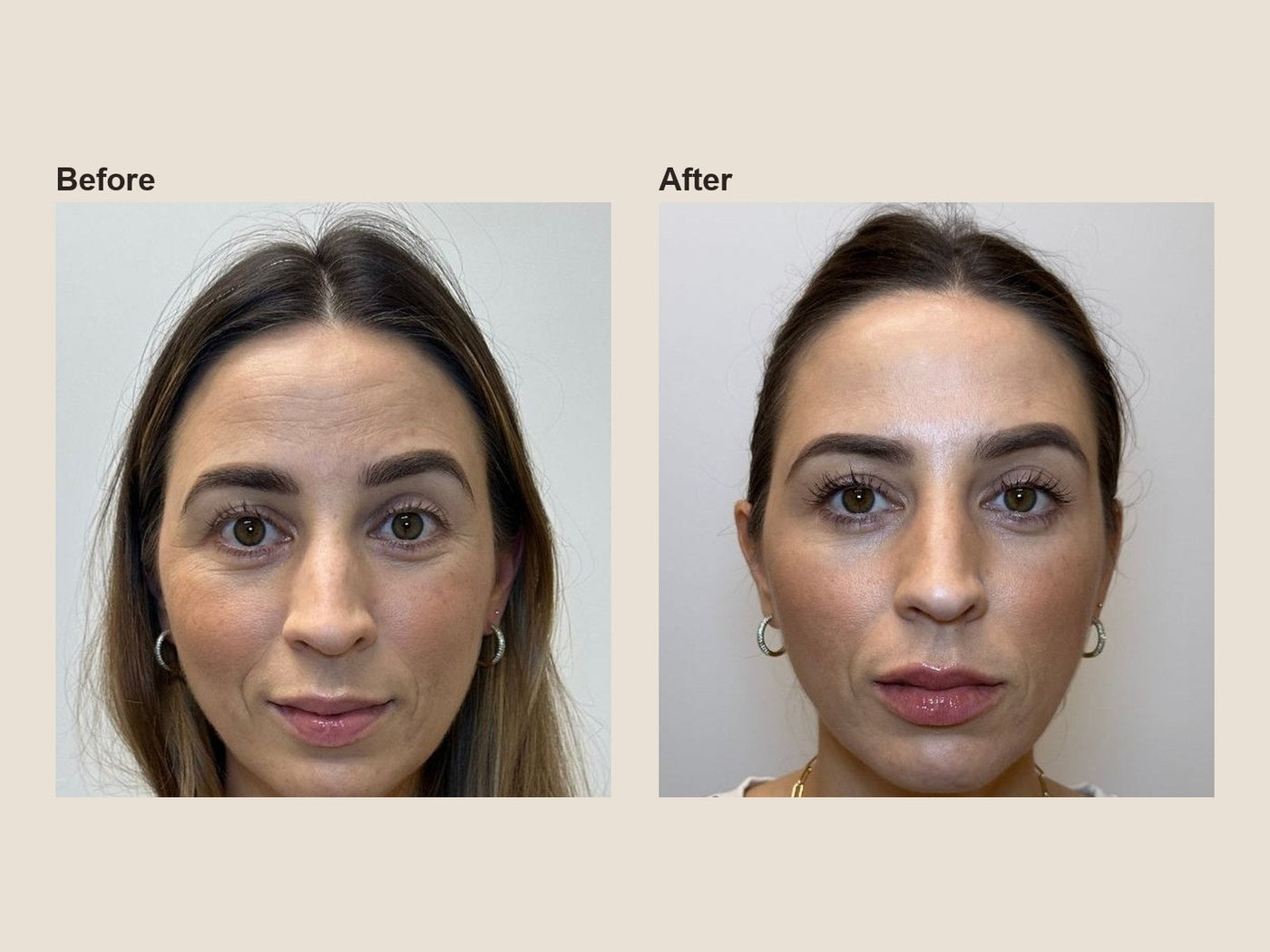 Before and after forehead wrinkle relaxer results at HoneMD