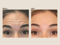 Before and after forehead wrinkle relaxer results at HoneMD