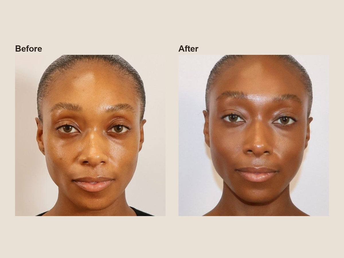 Before and after PRF microneedling results at HoneMD