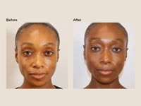 Before and after PRF microneedling results at HoneMD