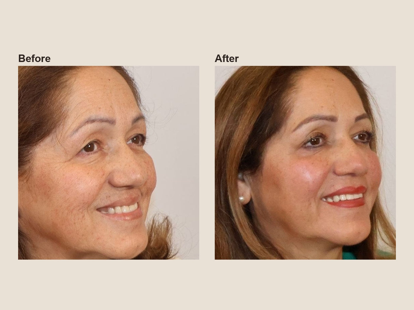 Before and after forehead wrinkle relaxer results at HoneMD