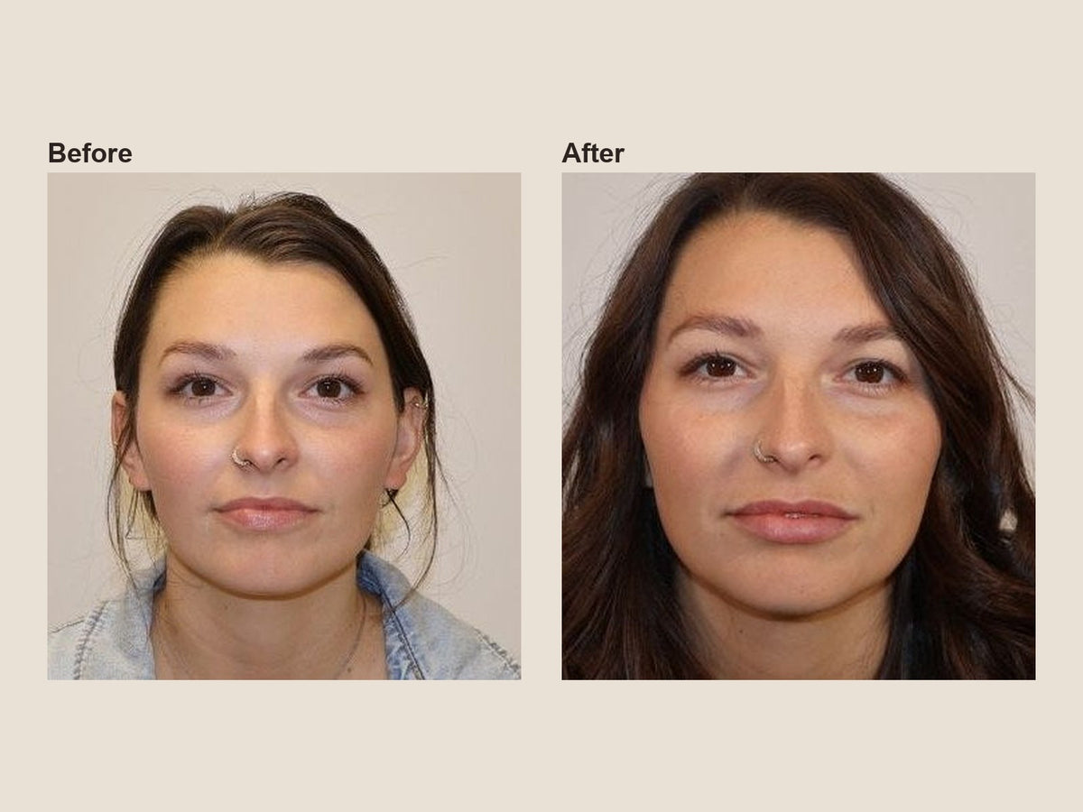 Before and after lip filler results at HoneMD