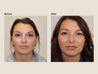 Before and after PRF microneedling results at HoneMD