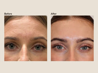 Before and after forehead wrinkle relaxer results at HoneMD