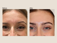 Before and after PRF microneedling results at HoneMD
