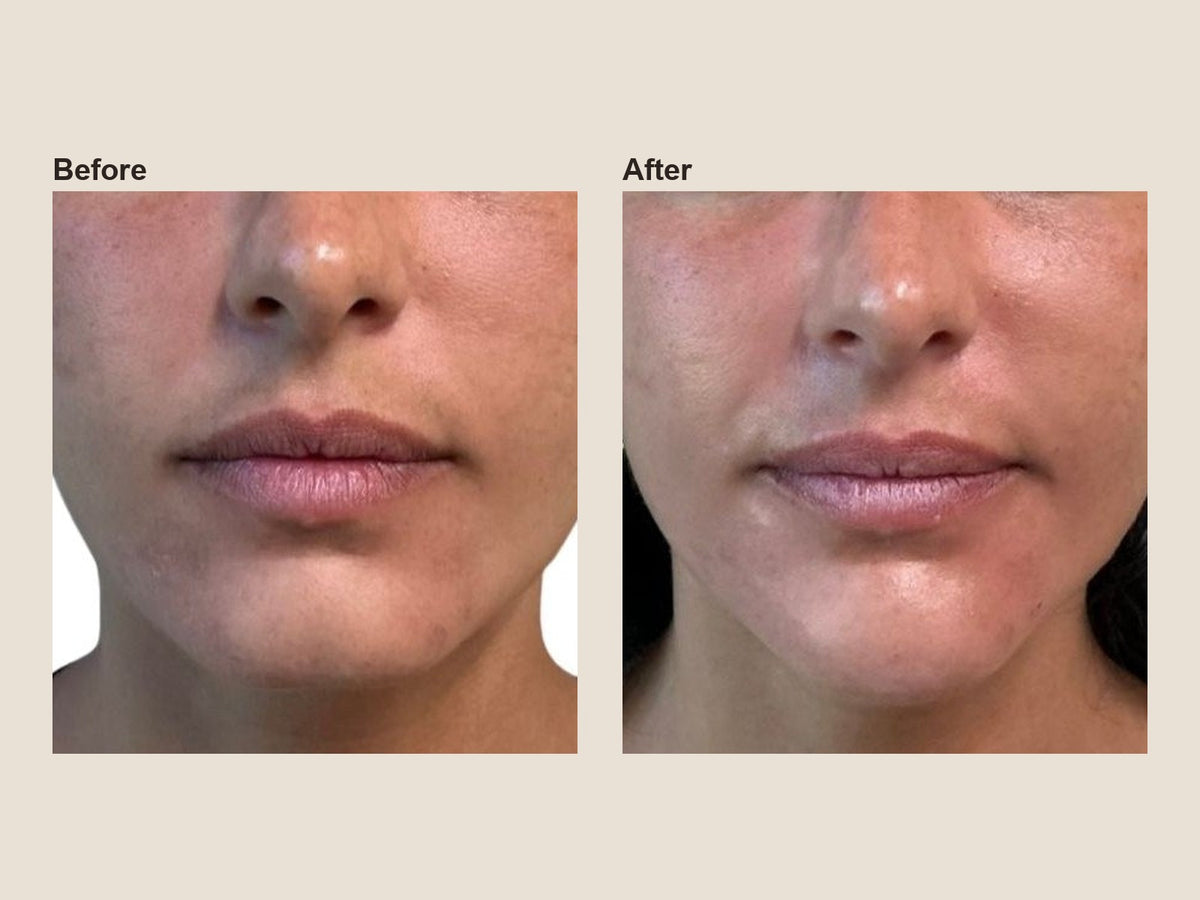 Before and after chin filler results at HoneMD