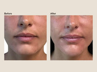 Before and after chin filler results at HoneMD