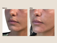 Before and after chin filler results at HoneMD