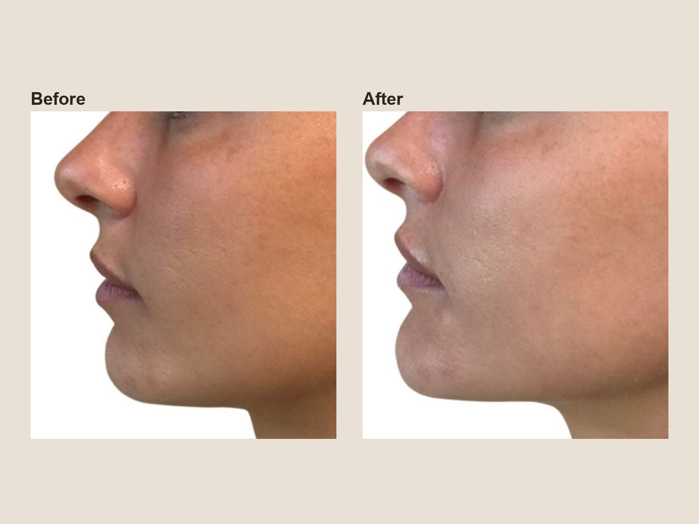 Before and after chin filler results at HoneMD