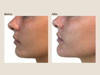 Before and after chin filler results at HoneMD