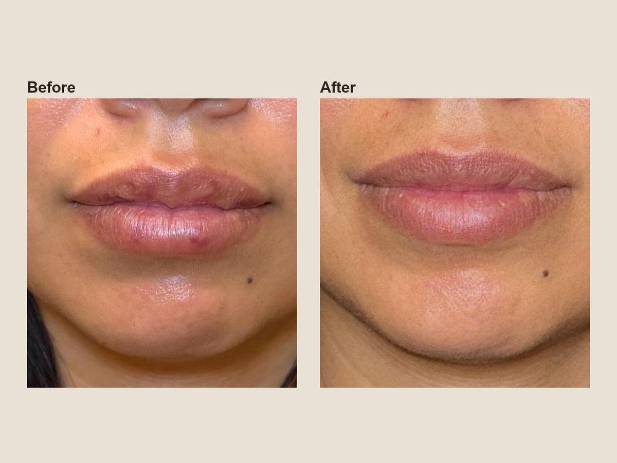 Before and after filler dissolving results at HoneMD