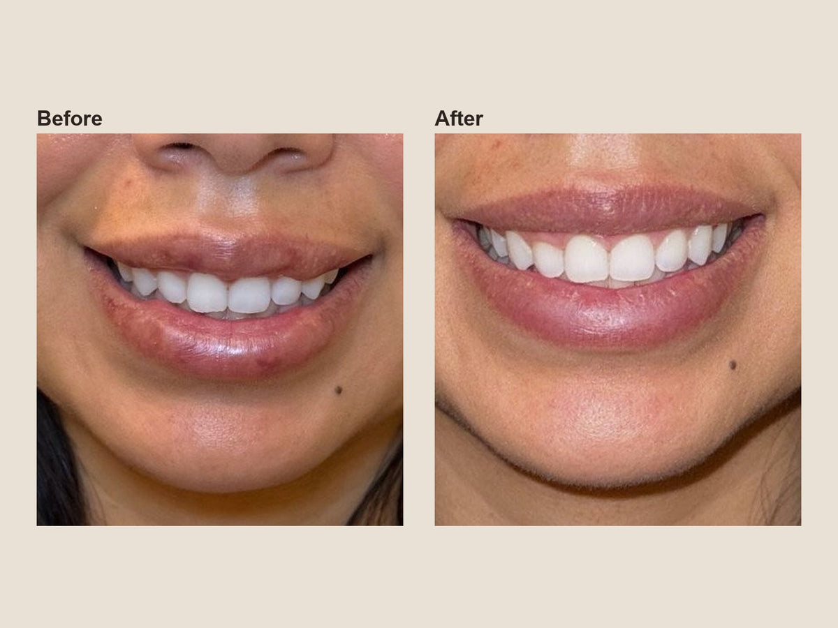 Before and after filler dissolving results at HoneMD