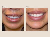 Before and after filler dissolving results at HoneMD
