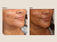 Before and after chin filler results at HoneMD