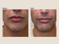 Before and after filler dissolving results at HoneMD