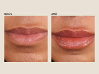 Before and after lip filler results at HoneMD