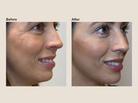 Before and after crow's feet wrinkle relaxer results at HoneMD
