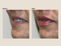 Before and after lip filler results at HoneMD
