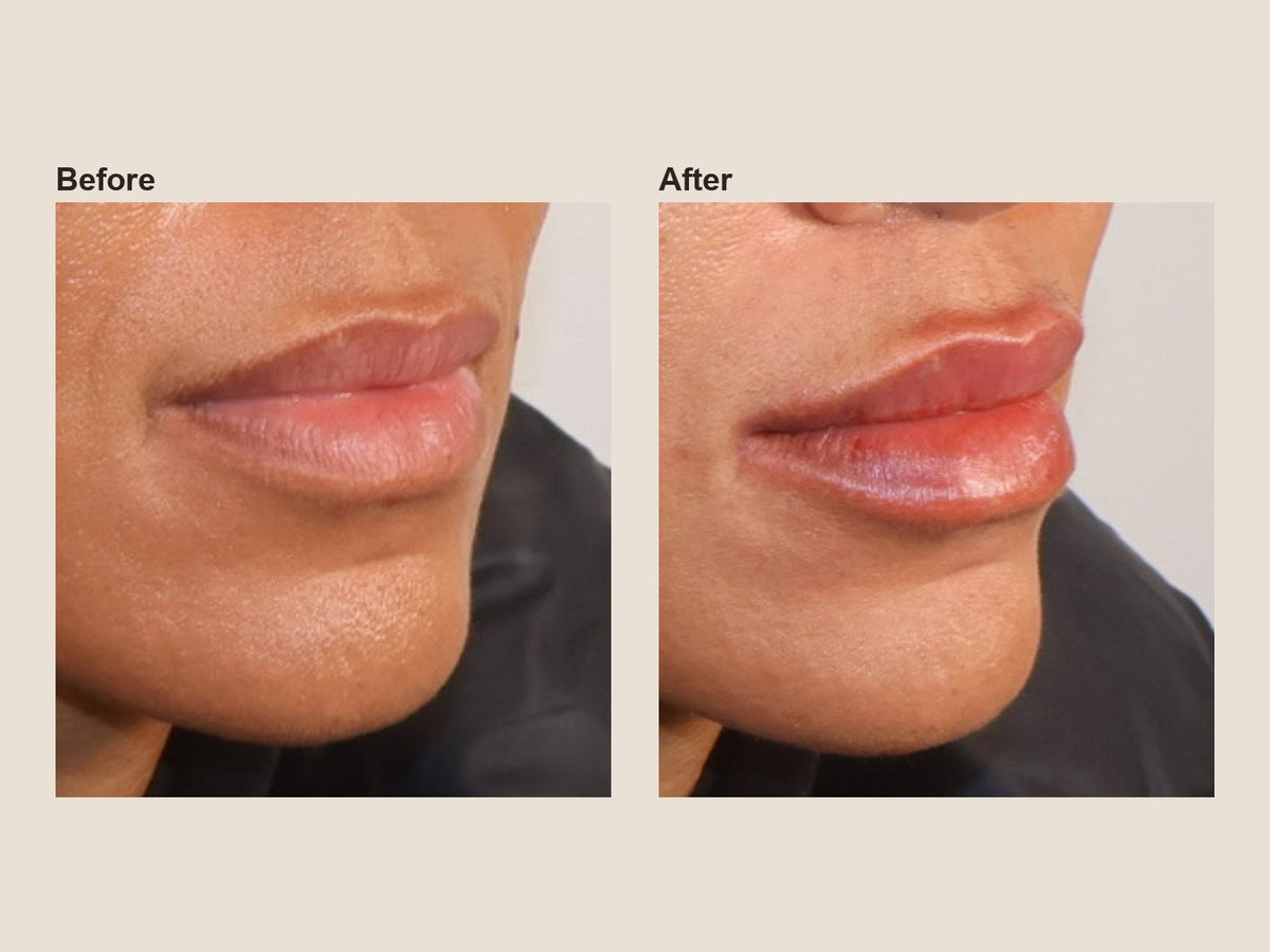 Before and after lip filler results at HoneMD