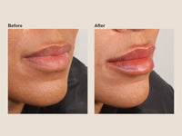 Before and after lip filler results at HoneMD