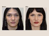 Before and after jawline filler results at HoneMD