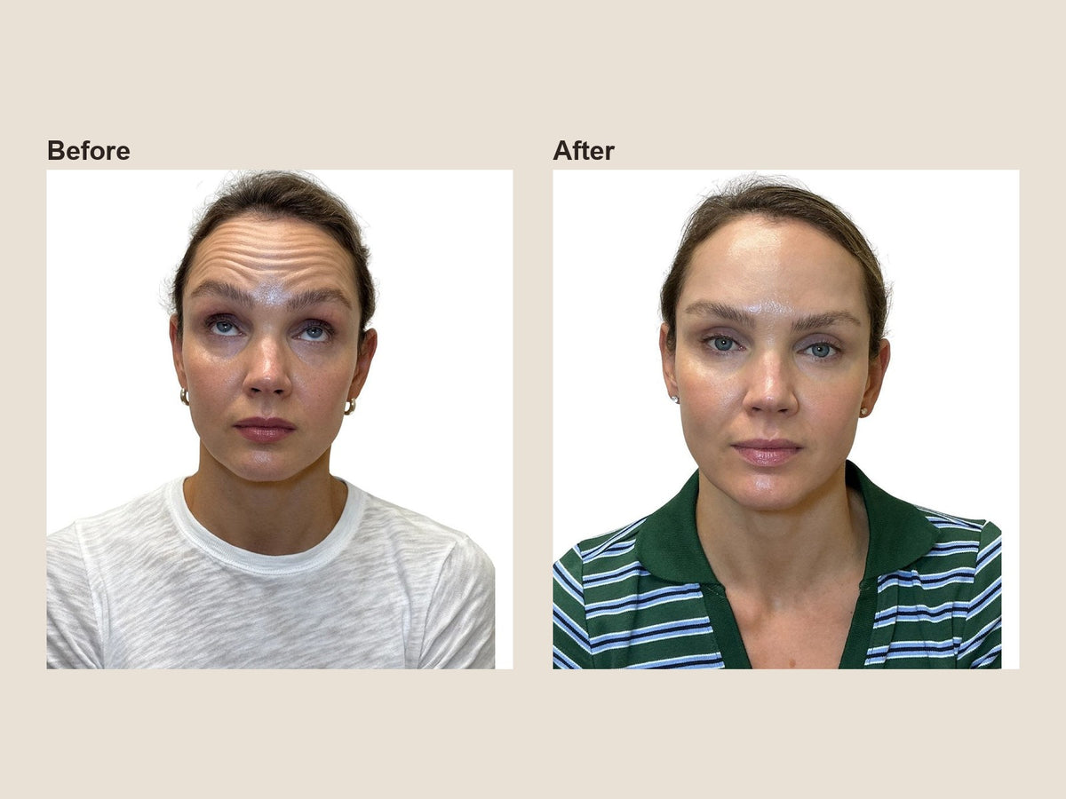 Before and after forehead wrinkle relaxer results at HoneMD