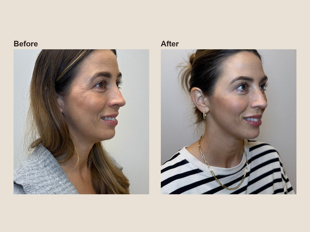 Before and after crow's feet wrinkle relaxer results at HoneMD