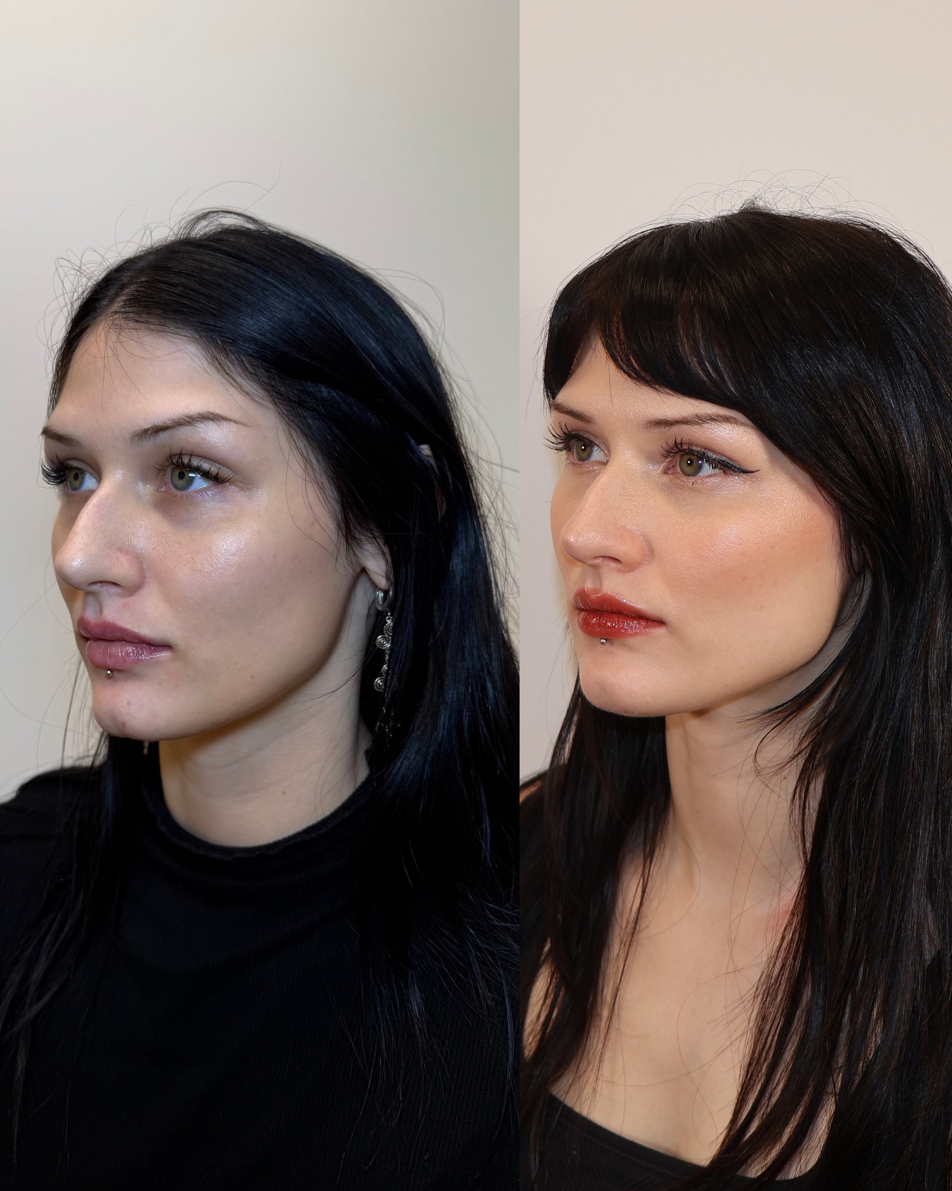 Before and after jawline filler showing enhanced jawline definition and mid-face contouring at HoneMD Torrance