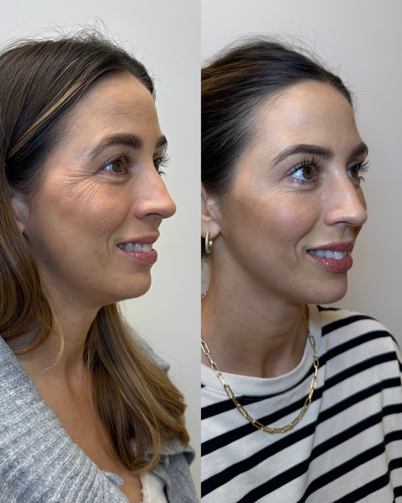 Before and after jawline filler results at HoneMD
